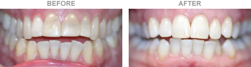 Porcelain Veneers in moorpark Before and after Treatment
